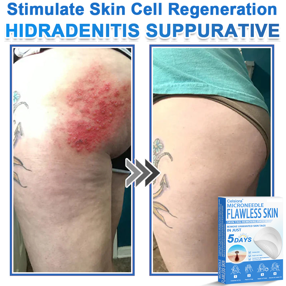 🔥 Neslemy® 2-in-1 Microneedle & Hydrocolloid Patch | Raised Moles,Acne,  Flat Warts & Skin Tags Remover | Improves Wrinkles, Scars & Blemishes | Invisible Pimple Patches for Face & Body