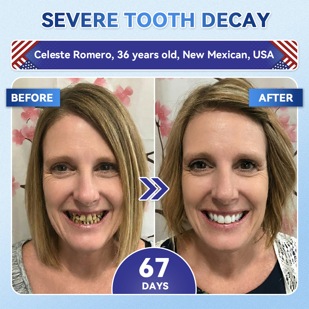 👨‍⚕️𝑶𝒇𝒇𝒊𝒄𝒊𝒂𝒍 𝑺𝒕𝒐𝒓𝒆  | Alisanda®🦷Tideglusib Fast‑Dissolving Tooth & Gum Repair Oral Strips ✨