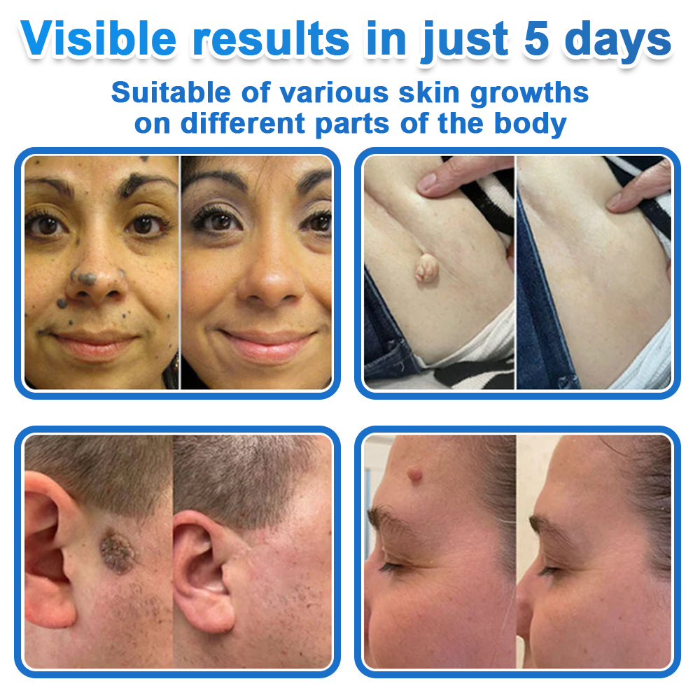 🔥 Neslemy® 2-in-1 Microneedle & Hydrocolloid Patch | Raised Moles,Acne,  Flat Warts & Skin Tags Remover | Improves Wrinkles, Scars & Blemishes | Invisible Pimple Patches for Face & Body