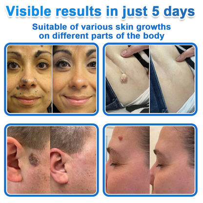 🔥 Neslemy® 2-in-1 Microneedle & Hydrocolloid Patch | Raised Moles,Acne,  Flat Warts & Skin Tags Remover | Improves Wrinkles, Scars & Blemishes | Invisible Pimple Patches for Face & Body