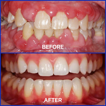 🔥Last Day 80% OFF 👨‍⚕️  NESLEMY® Bee Venom Dental Treatment Toothpaste