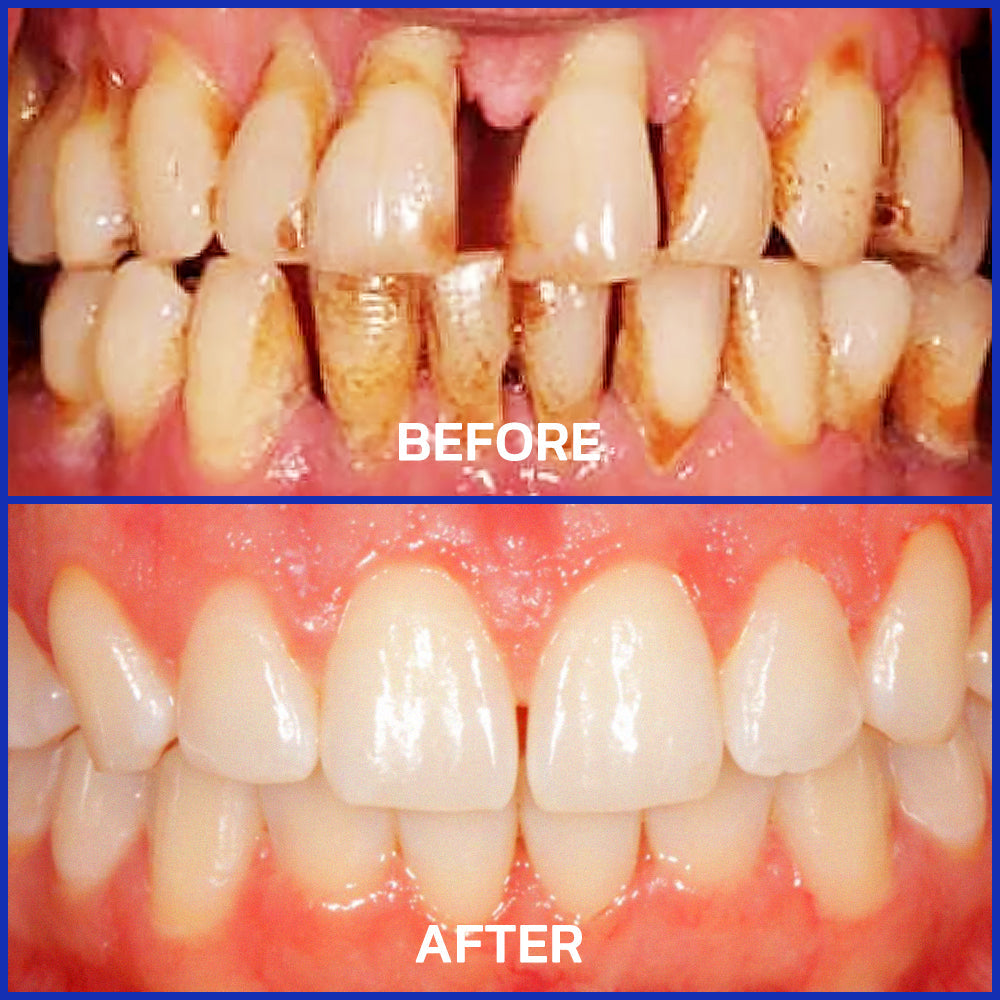 🔥Last Day 80% OFF 👨‍⚕️  NESLEMY® Bee Venom Dental Treatment Toothpaste